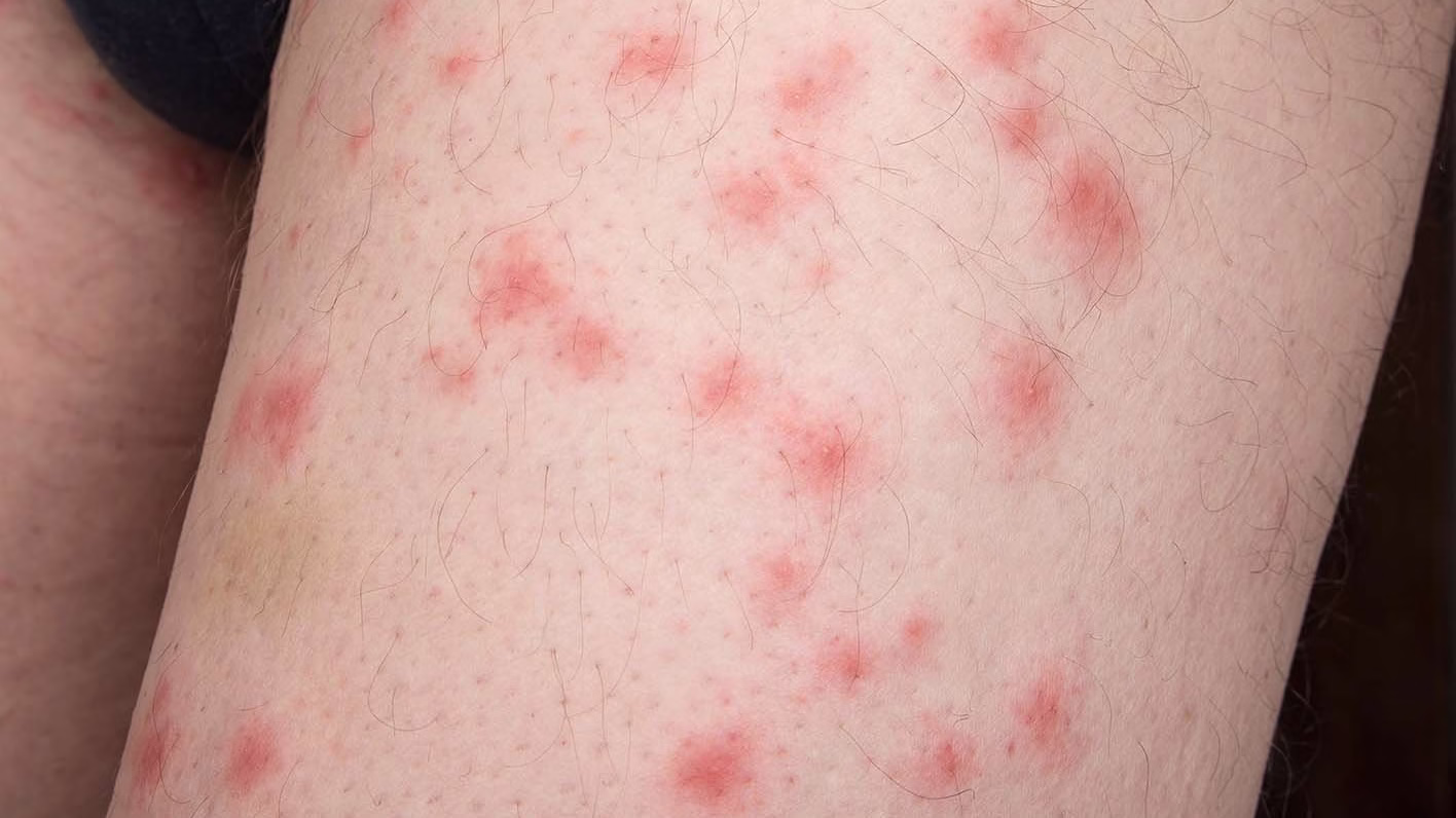 bedbug bites on skin