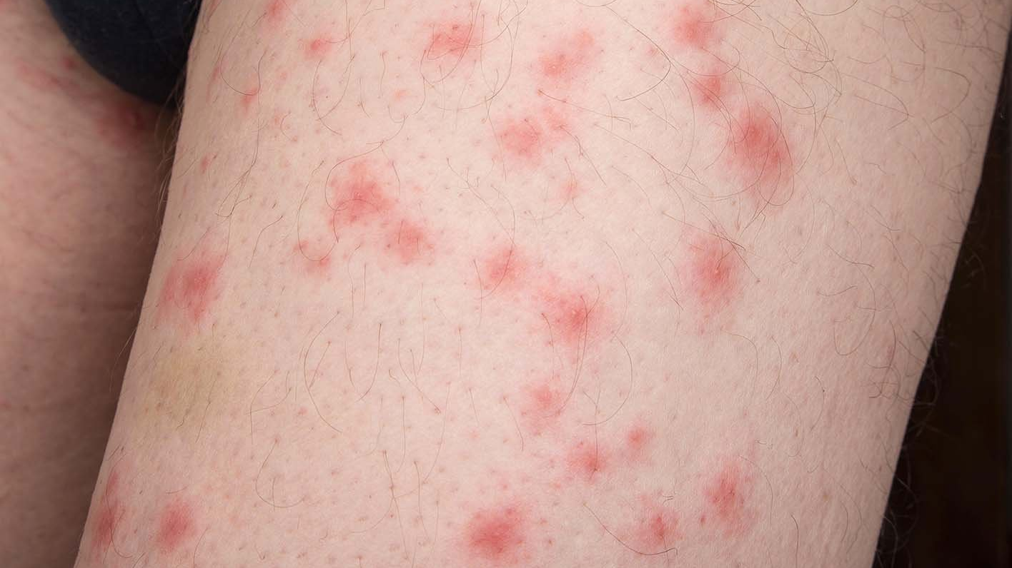bedbug bites on skin